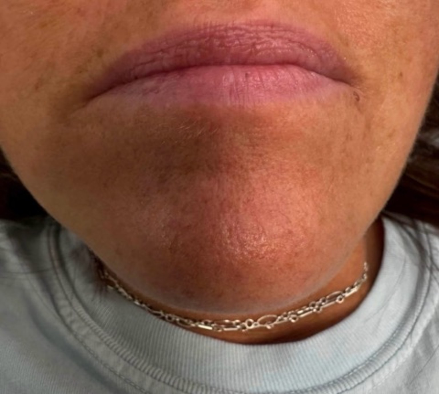 Lips before lip blushing
