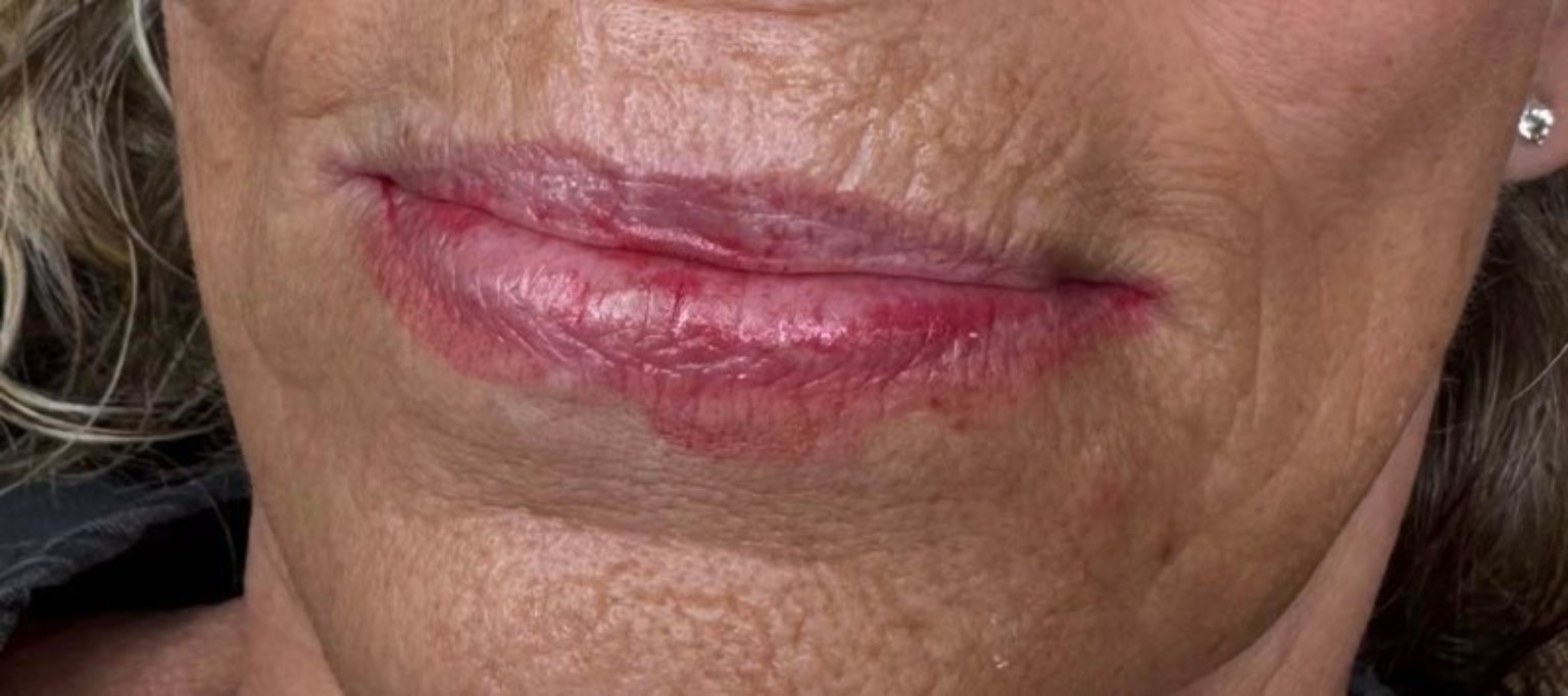 Lips before lip blushing